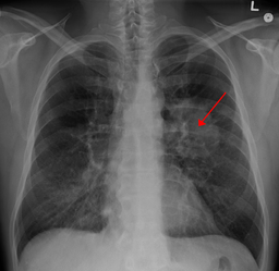 Marijuana Fact #5: smoking weed does not cause, and may inhibit, lung cancer.